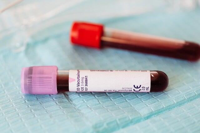 Entendiendo la Prueba de Colesterol en Sangre en Laboratorios de Análisis Clínicos